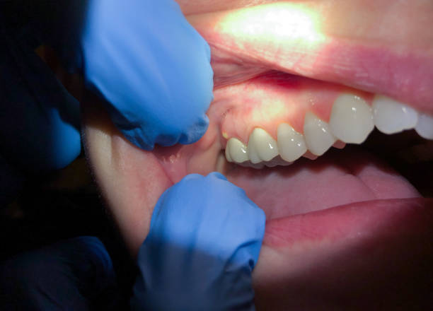 Best Chipped Tooth Repair Near Me  in Vance, AL